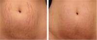 Microneedling For Stretch Marks image 7